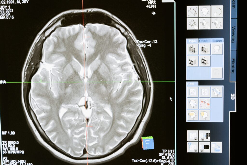 Brain-Injury2-1024x683