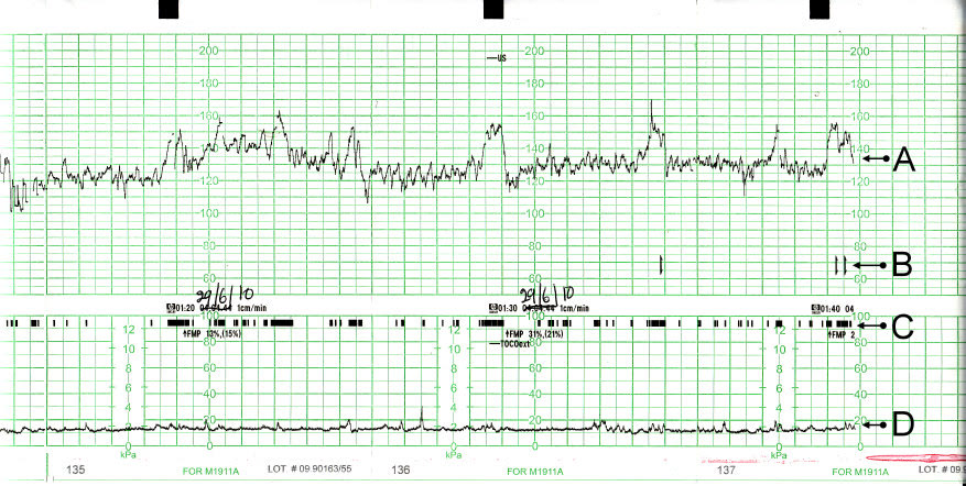 Annotated cardiotocograph (CTG) trace showing the fetal heart rate and uterine contractions